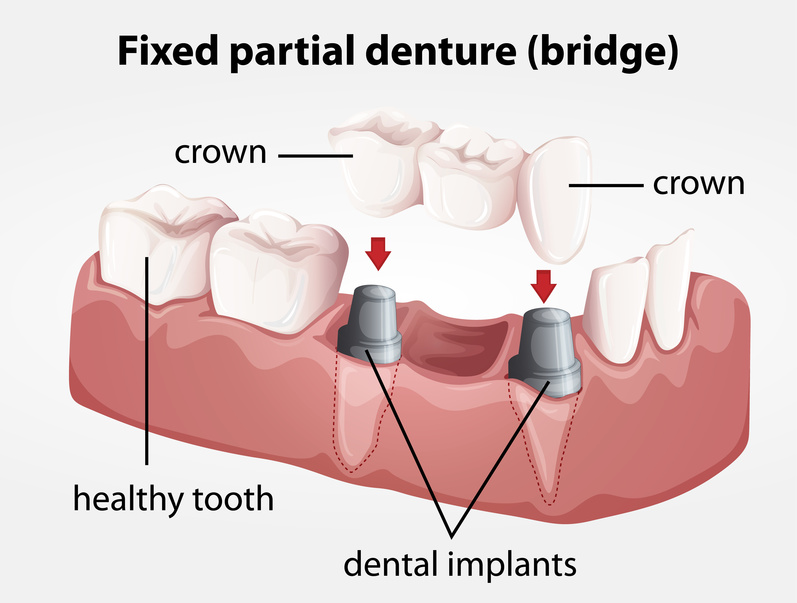 dental implant provider